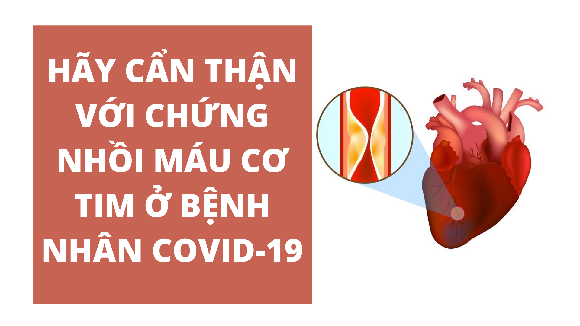     HÃY CẨN THẬN VỚI CHỨNG NHỒI MÁU CƠ TIM Ở BỆNH NHÂN COVID-19